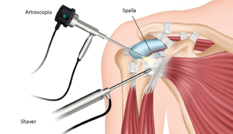 artroscopia-spalla